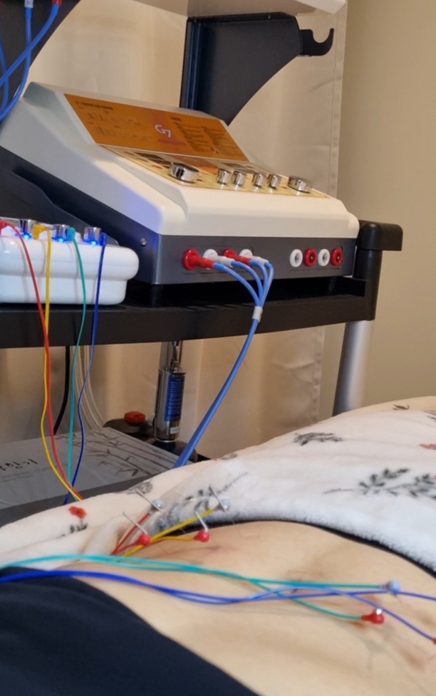 Electro-acupuncture treatment for metabolic weight management at Harmonia Clinic, Port Moody.